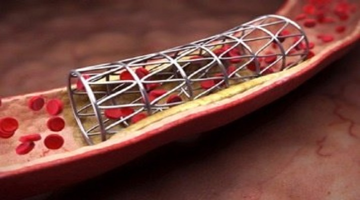 Increasing And Developing Insights Of The Worldwide Vascular Stents Market Outlook: Ken Research